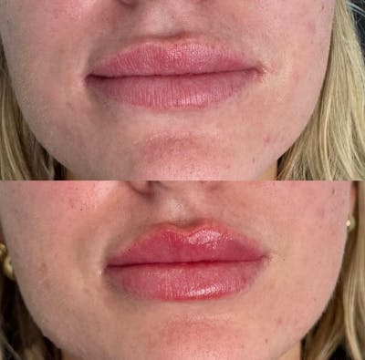 Facial Fillers Before & After Gallery - Patient 468194 - Image 1