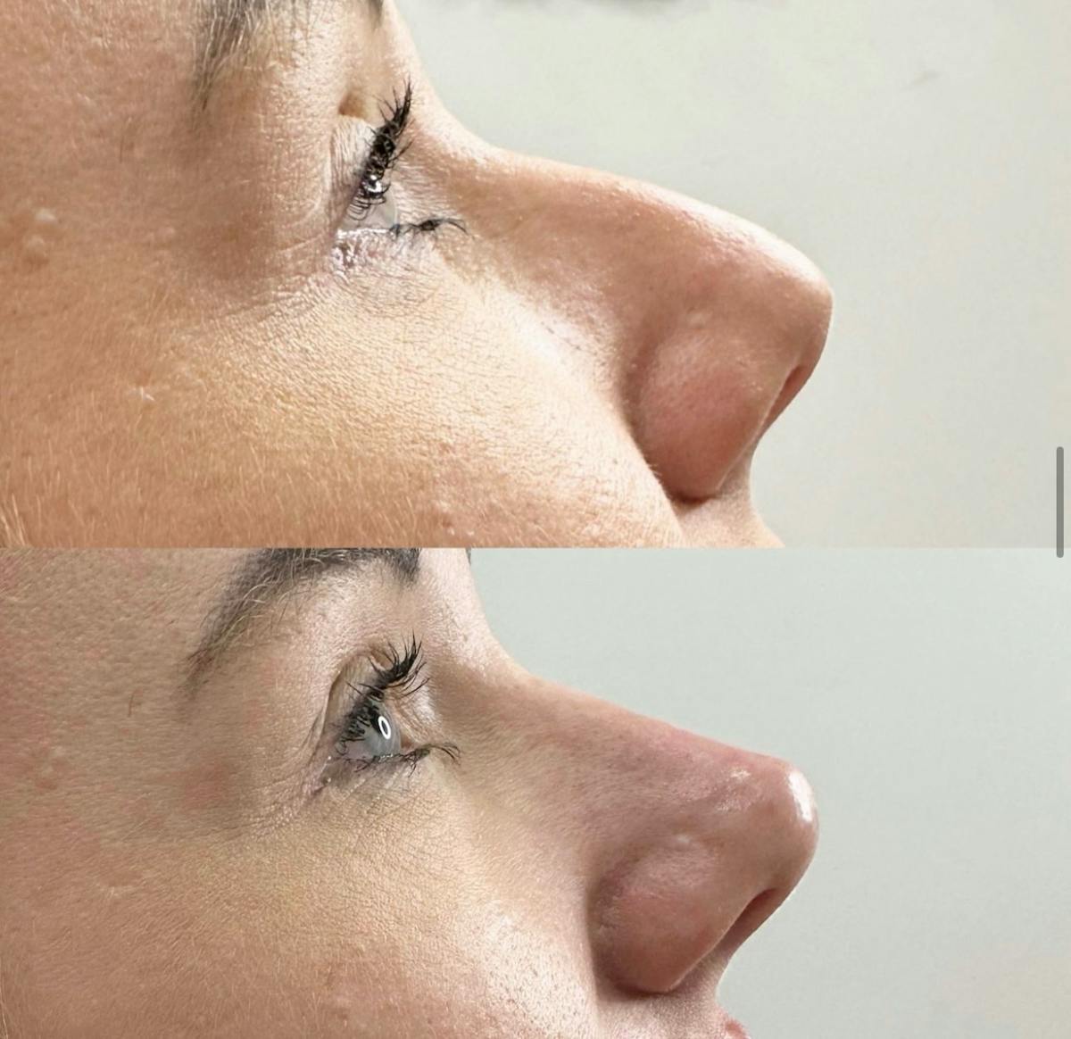 Facial Fillers Before & After Gallery - Patient 764288 - Image 1