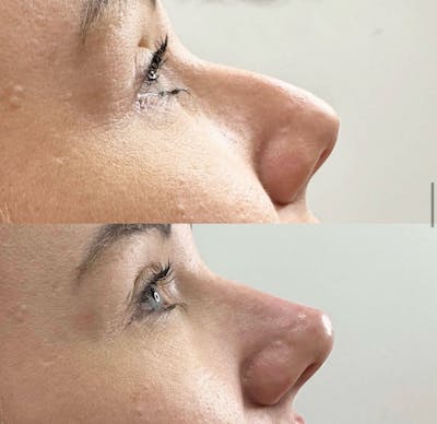 Facial Fillers Before & After Gallery - Patient 764288 - Image 1
