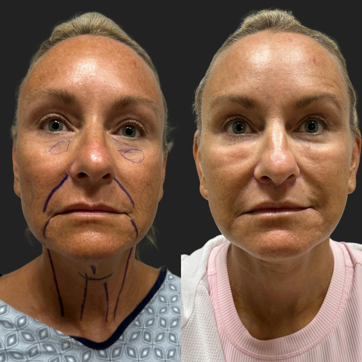 Facelift Before & After Gallery - Patient 805789 - Image 2