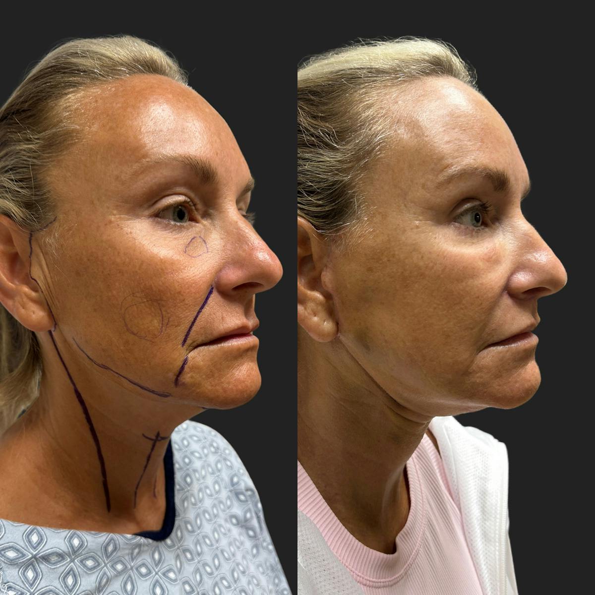 Facelift Before & After Gallery - Patient 805789 - Image 1