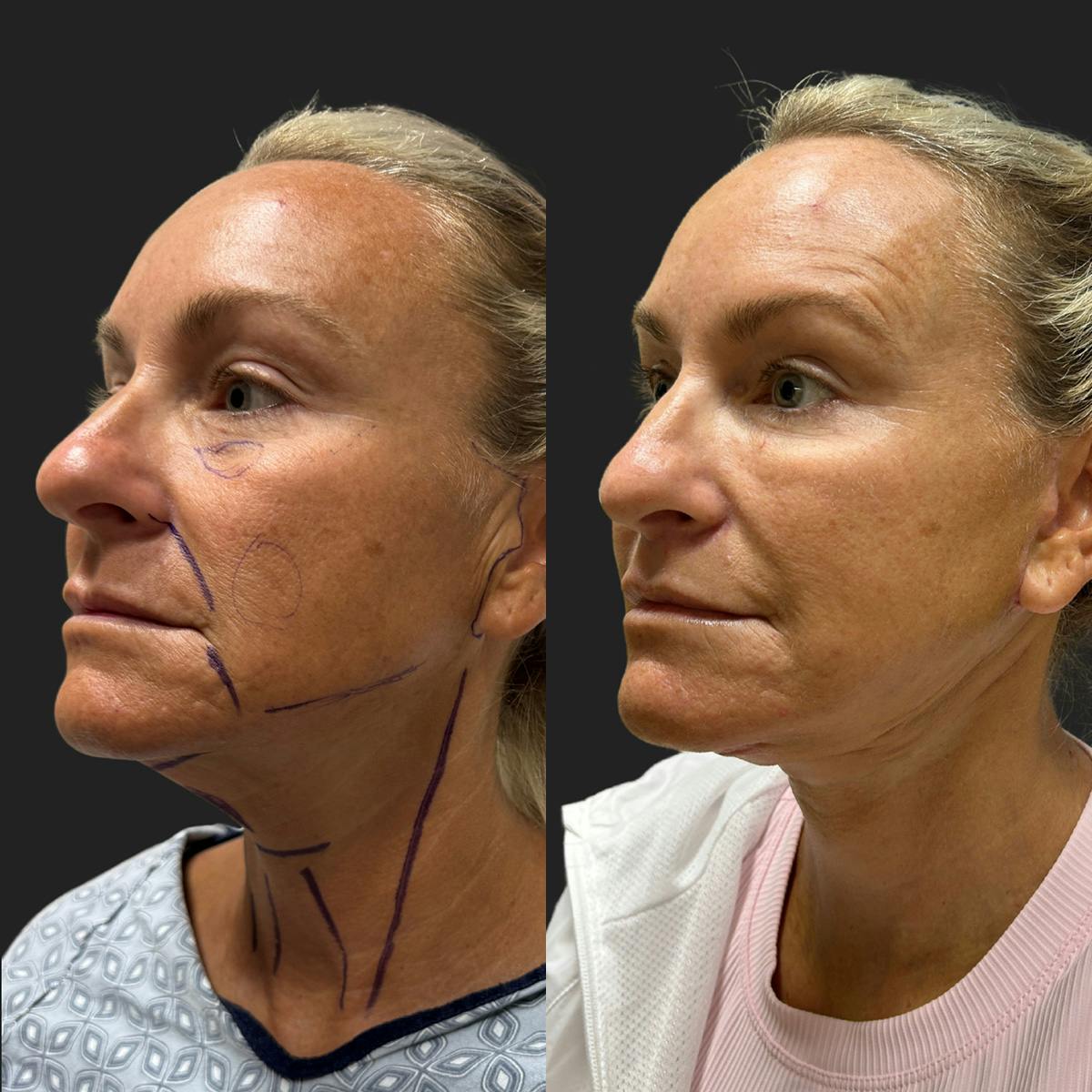Facelift Before & After Gallery - Patient 805789 - Image 3