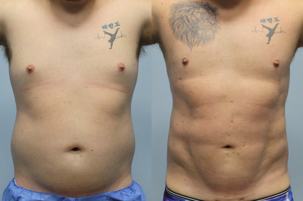 Hi Def Liposuction Before & After Gallery - Patient 393161 - Image 1