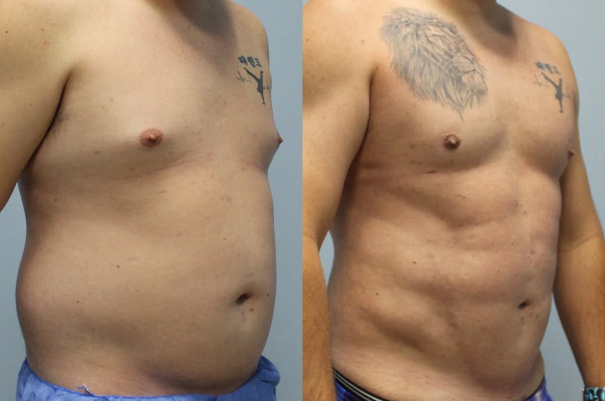 Hi Def Liposuction Before & After Gallery - Patient 393161 - Image 2