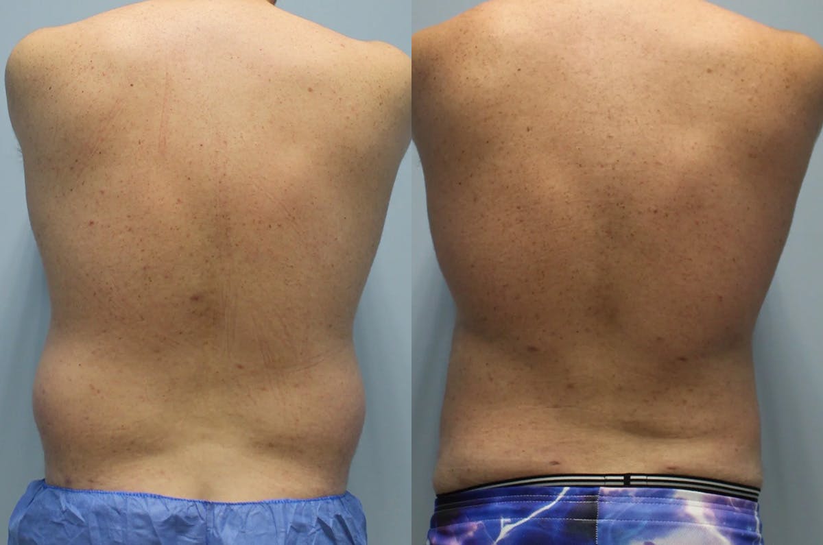 Hi Def Liposuction Before & After Gallery - Patient 393161 - Image 5