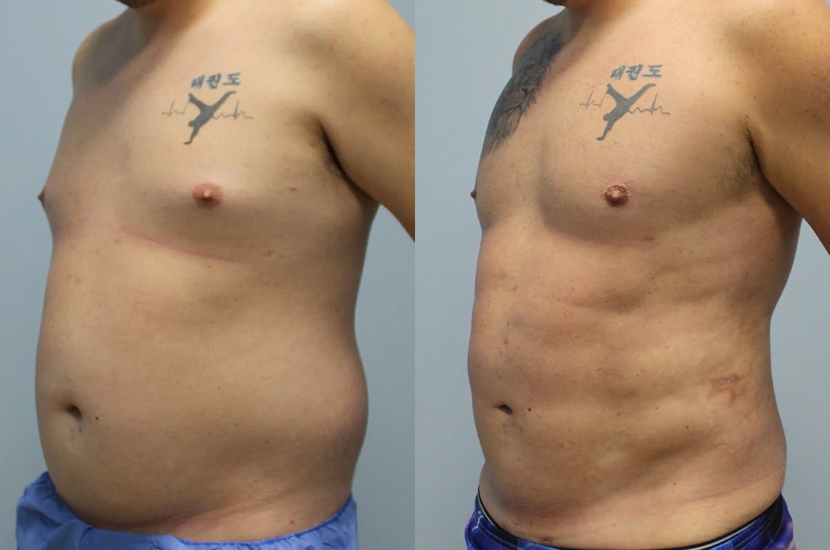 Hi Def Liposuction Before & After Gallery - Patient 393161 - Image 3