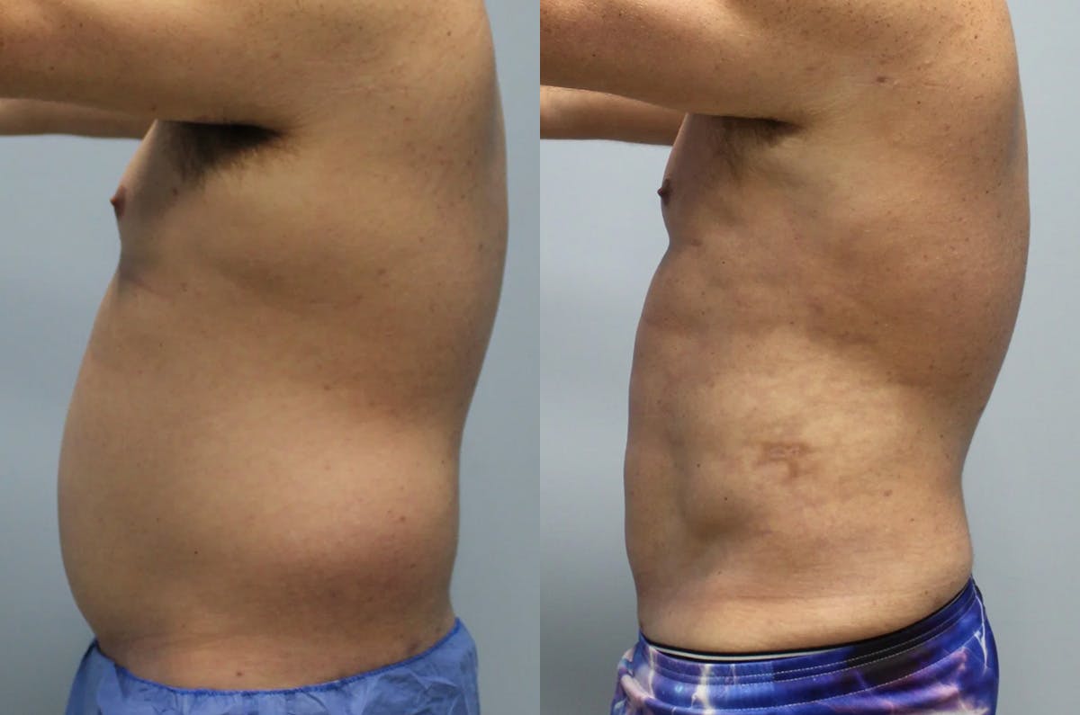 Hi Def Liposuction Before & After Gallery - Patient 393161 - Image 4