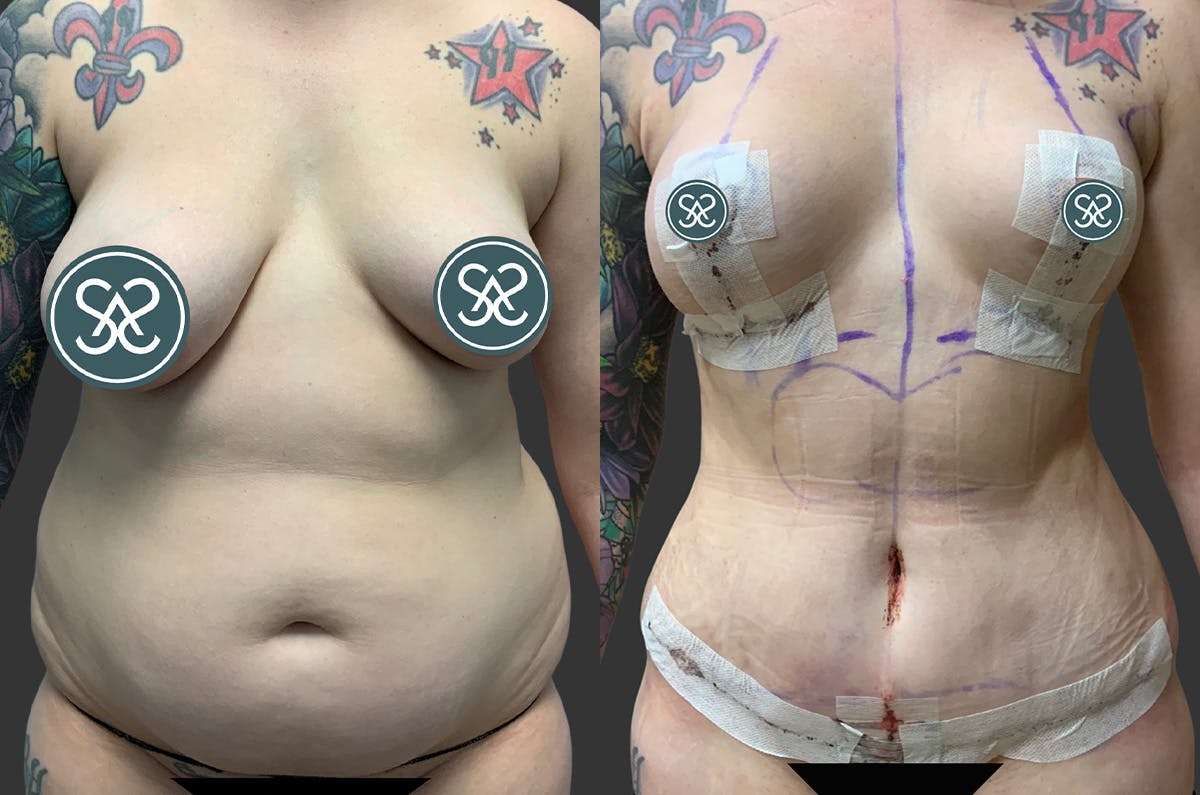 Tummy Tuck Before & After Gallery - Patient 354419 - Image 1