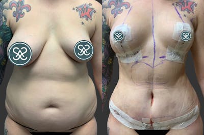 Hi Def Liposuction Before & After Gallery - Patient 365116 - Image 1