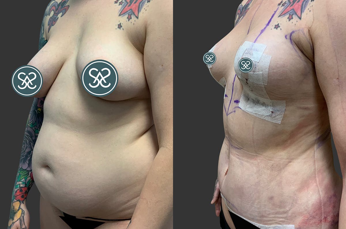 Tummy Tuck Before & After Gallery - Patient 354419 - Image 2