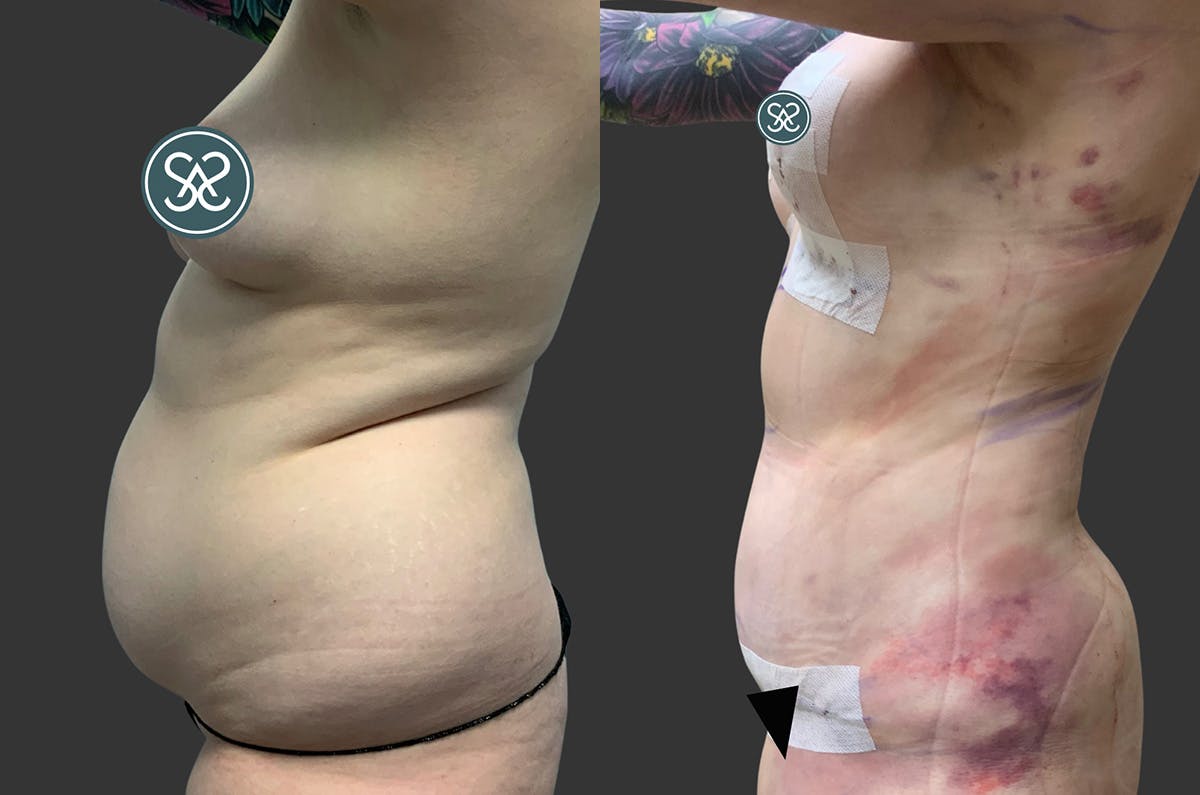 Tummy Tuck Before & After Gallery - Patient 354419 - Image 3