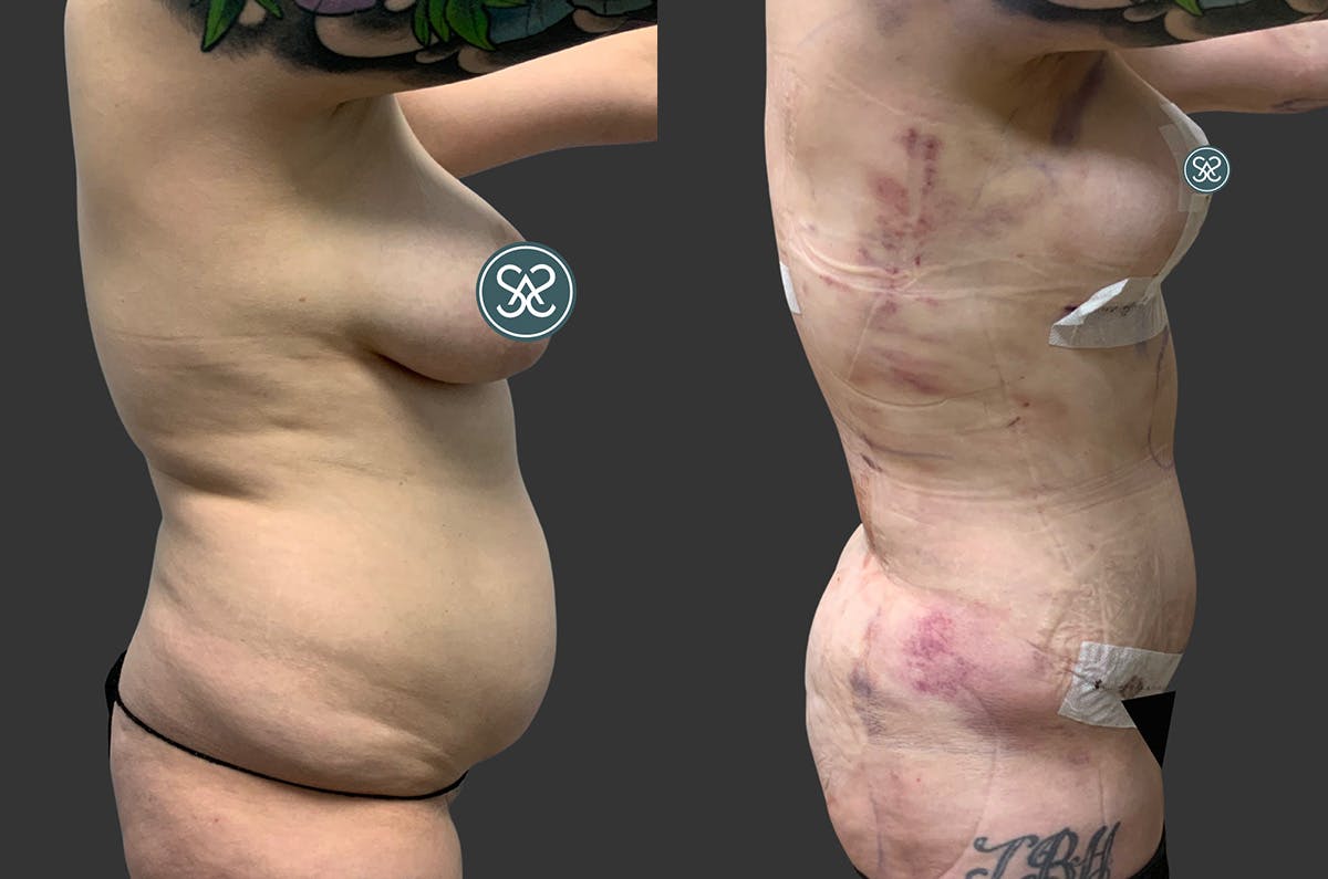 Tummy Tuck Before & After Gallery - Patient 354419 - Image 4