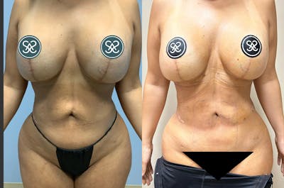 Rib Tuck Before & After Gallery - Patient 295303 - Image 1