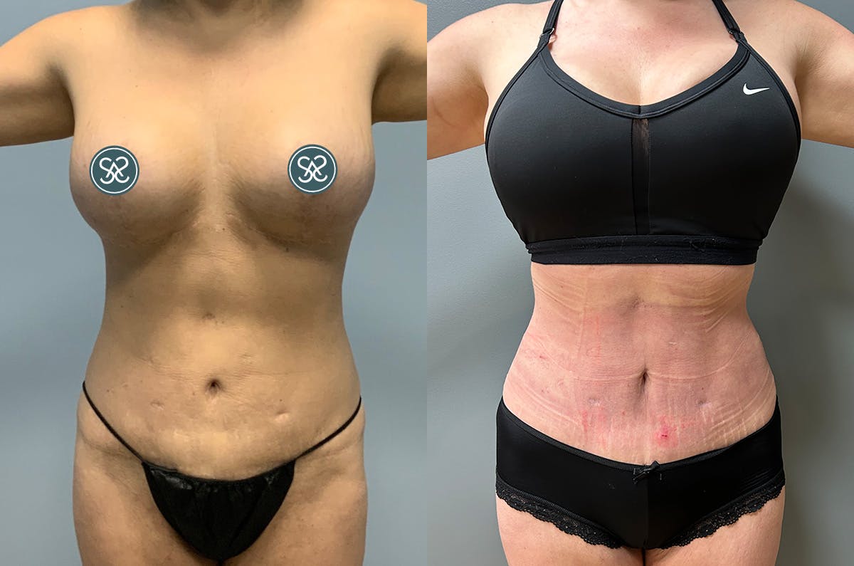 Rib Tuck Before & After Gallery - Patient 334104 - Image 1