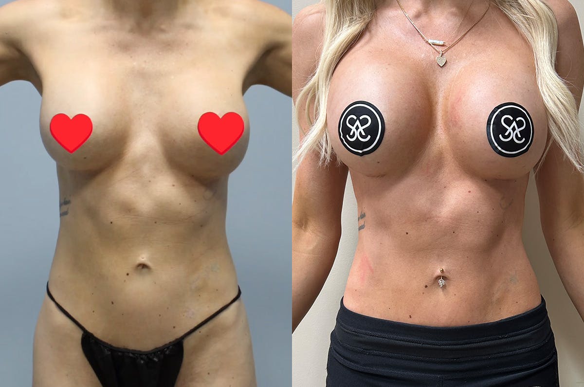 Rib Tuck Before & After Gallery - Patient 385039 - Image 1