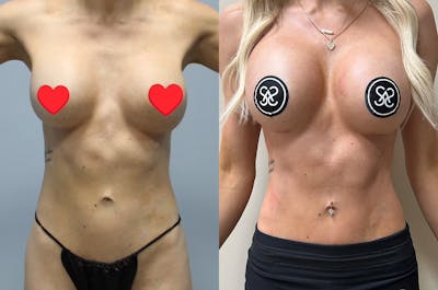 Rib Tuck Before & After Gallery - Patient 385039 - Image 1