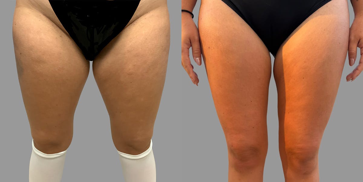 Liposuction Before & After Gallery - Patient 211440 - Image 1