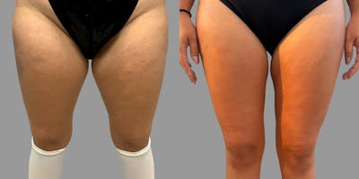 Liposuction Before & After Gallery - Patient 211440 - Image 1