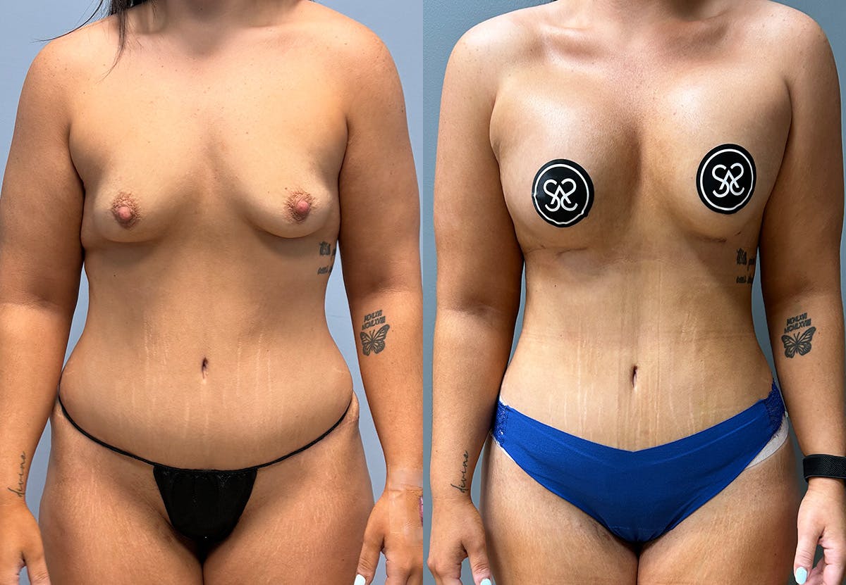 Tummy Tuck Before & After Gallery - Patient 231081 - Image 1