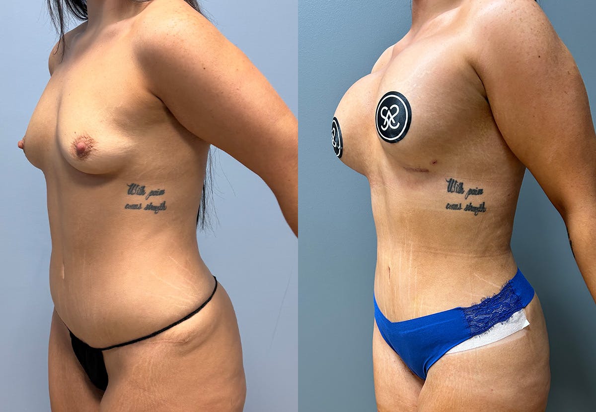 Tummy Tuck Before & After Gallery - Patient 231081 - Image 4
