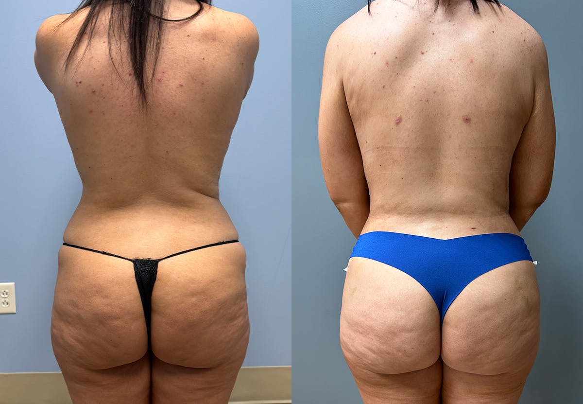 Tummy Tuck Before & After Gallery - Patient 231081 - Image 5