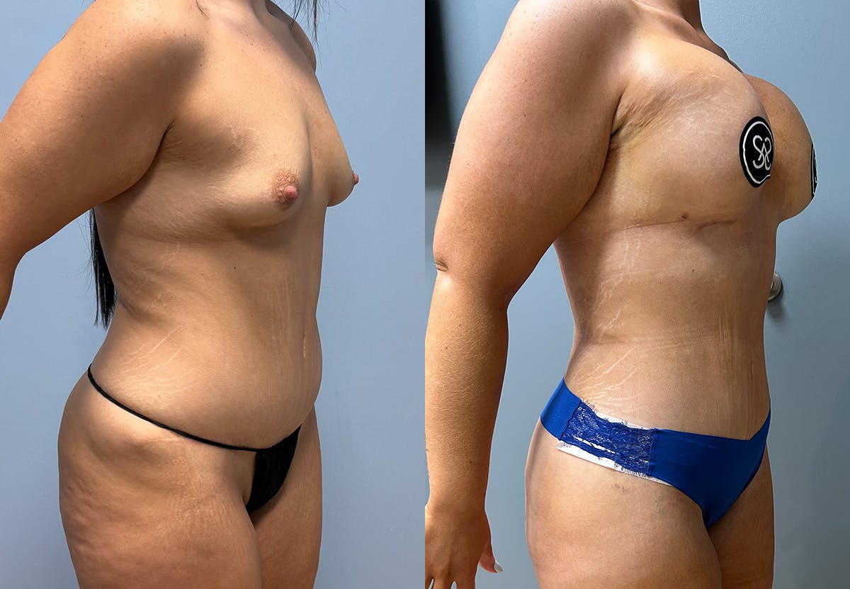 Tummy Tuck Before & After Gallery - Patient 231081 - Image 2
