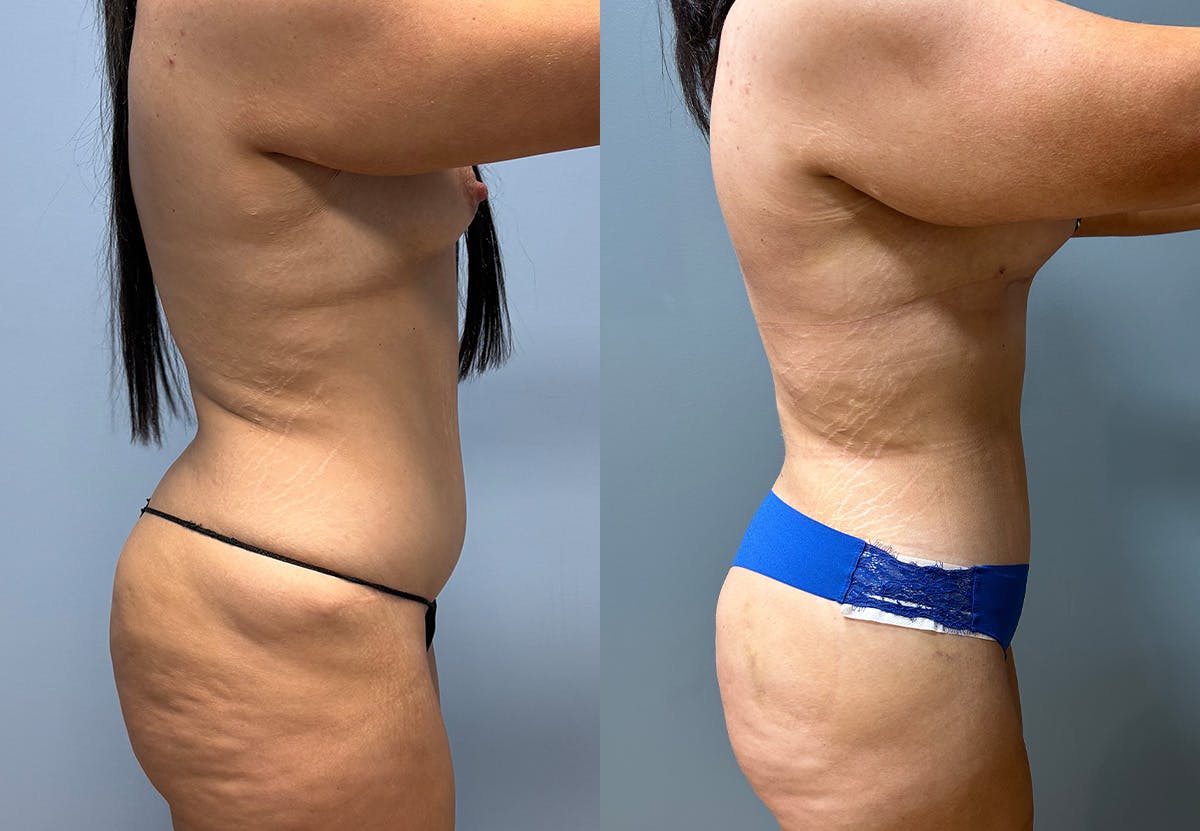 Tummy Tuck Before & After Gallery - Patient 231081 - Image 3