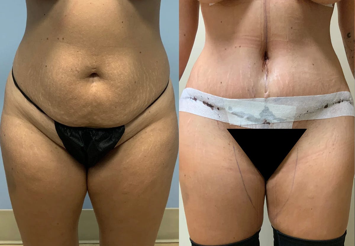 Tummy Tuck Before & After Gallery - Patient 887627 - Image 1