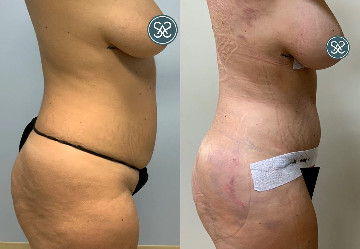 Tummy Tuck Before & After Gallery - Patient 887627 - Image 2