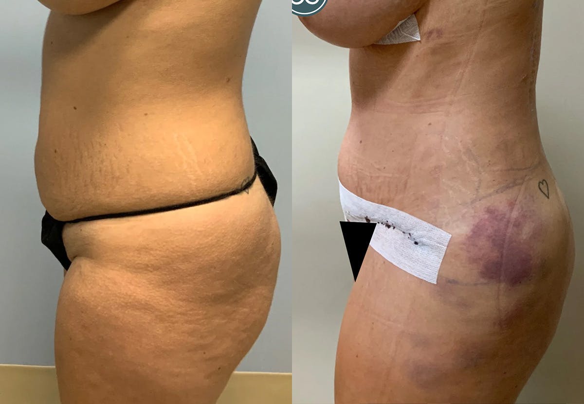 Tummy Tuck Before & After Gallery - Patient 887627 - Image 3