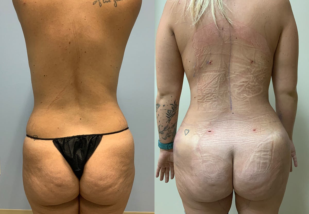 Tummy Tuck Before & After Gallery - Patient 887627 - Image 4
