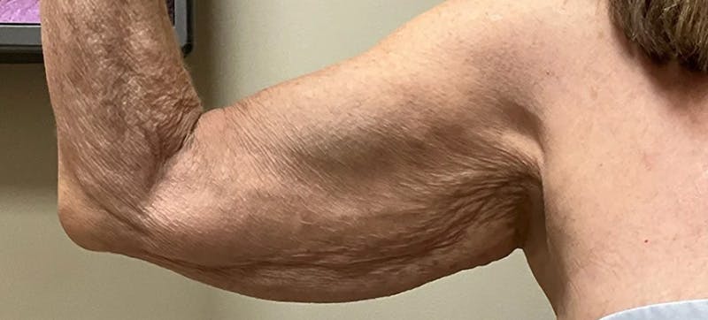 Arm Lift (Scarless Arm Lift) Before & After Gallery - Patient 347533 - Image 1