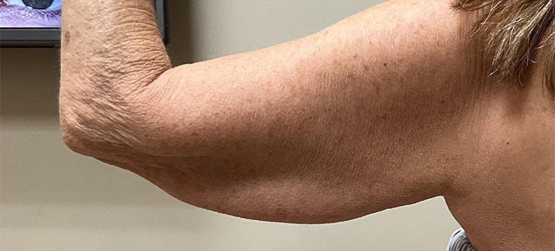 Arm Lift (Scarless Arm Lift) Before & After Gallery - Patient 347533 - Image 5
