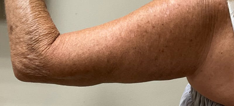 Arm Lift (Scarless Arm Lift) Before & After Gallery - Patient 347533 - Image 6