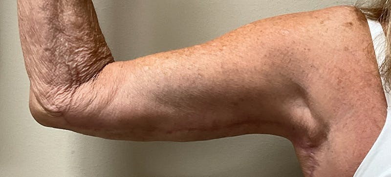 Arm Lift (Scarless Arm Lift) Before & After Gallery - Patient 347533 - Image 2