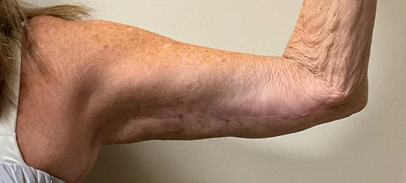 Arm Lift (Scarless Arm Lift) Before & After Gallery - Patient 347533 - Image 4