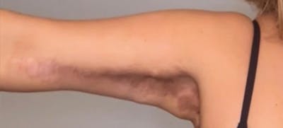 Arm Lift (Scarless Arm Lift) Before & After Gallery - Patient 164573 - Image 1