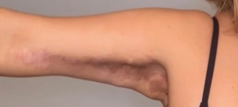 Arm Lift (Scarless Arm Lift) Before & After Gallery - Patient 164573 - Image 1