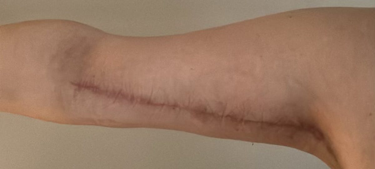 Arm Lift (Scarless Arm Lift) Before & After Gallery - Patient 164573 - Image 2