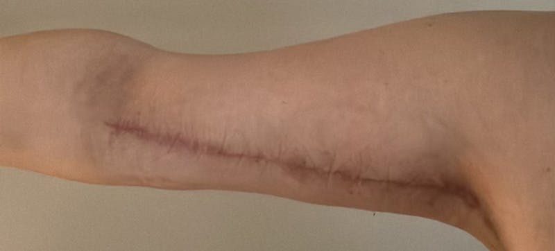 Arm Lift (Scarless Arm Lift) Before & After Gallery - Patient 164573 - Image 2