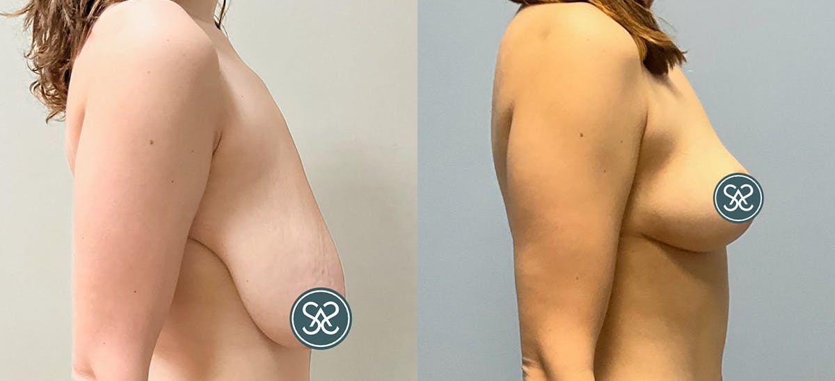 Breast Augmentation Before & After Gallery - Patient 286188 - Image 2