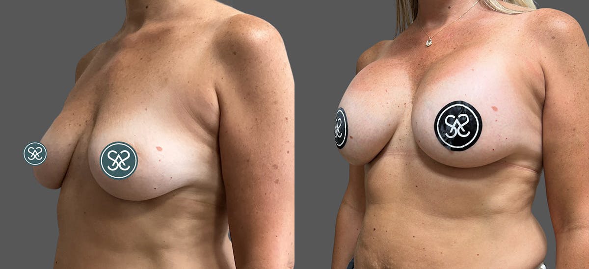 Breast Augmentation Before & After Gallery - Patient 578547 - Image 3