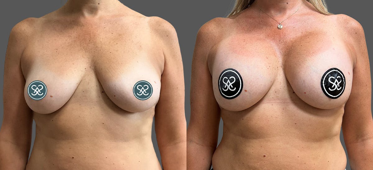 Breast Augmentation Before & After Gallery - Patient 578547 - Image 1