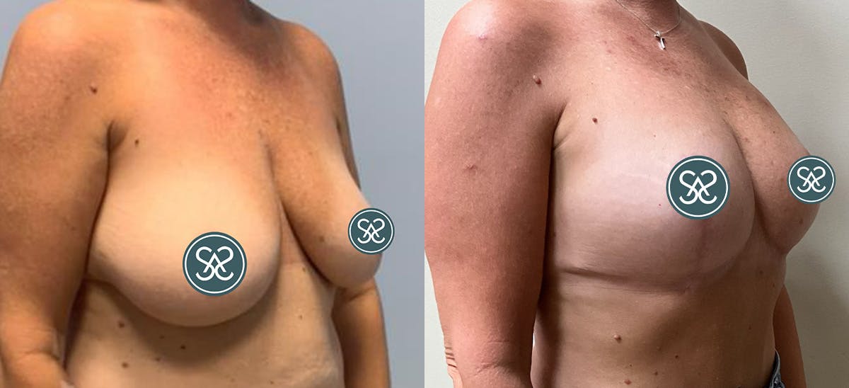 Breast Augmentation Before & After Gallery - Patient 242668 - Image 2