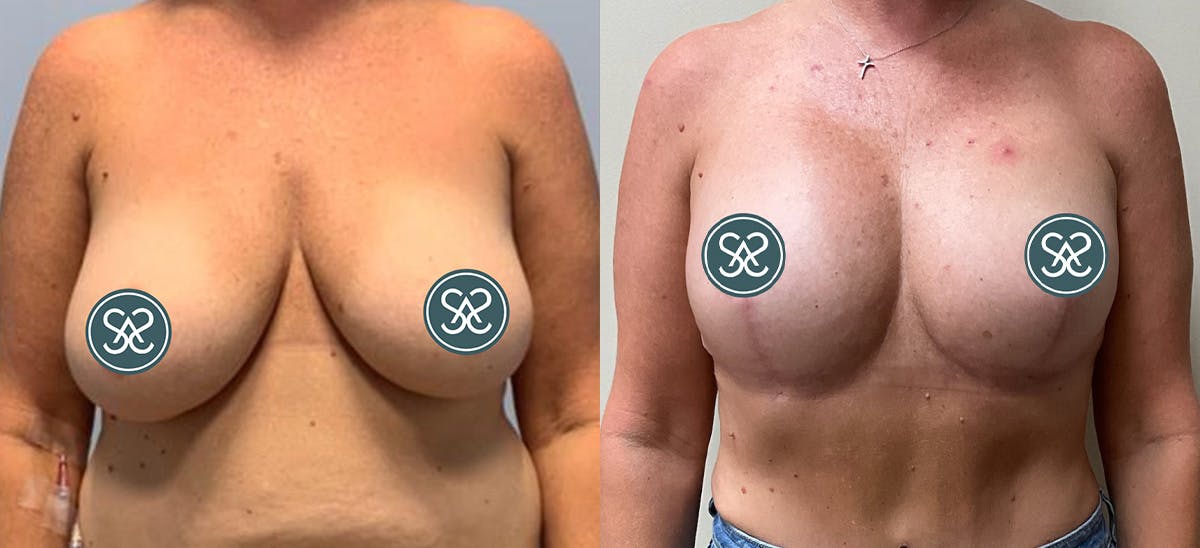 Breast Augmentation Before & After Gallery - Patient 242668 - Image 1