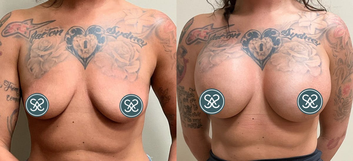 Breast Augmentation Before & After Gallery - Patient 110733 - Image 1