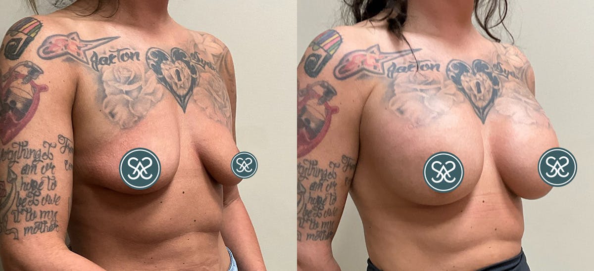 Breast Augmentation Before & After Gallery - Patient 110733 - Image 2