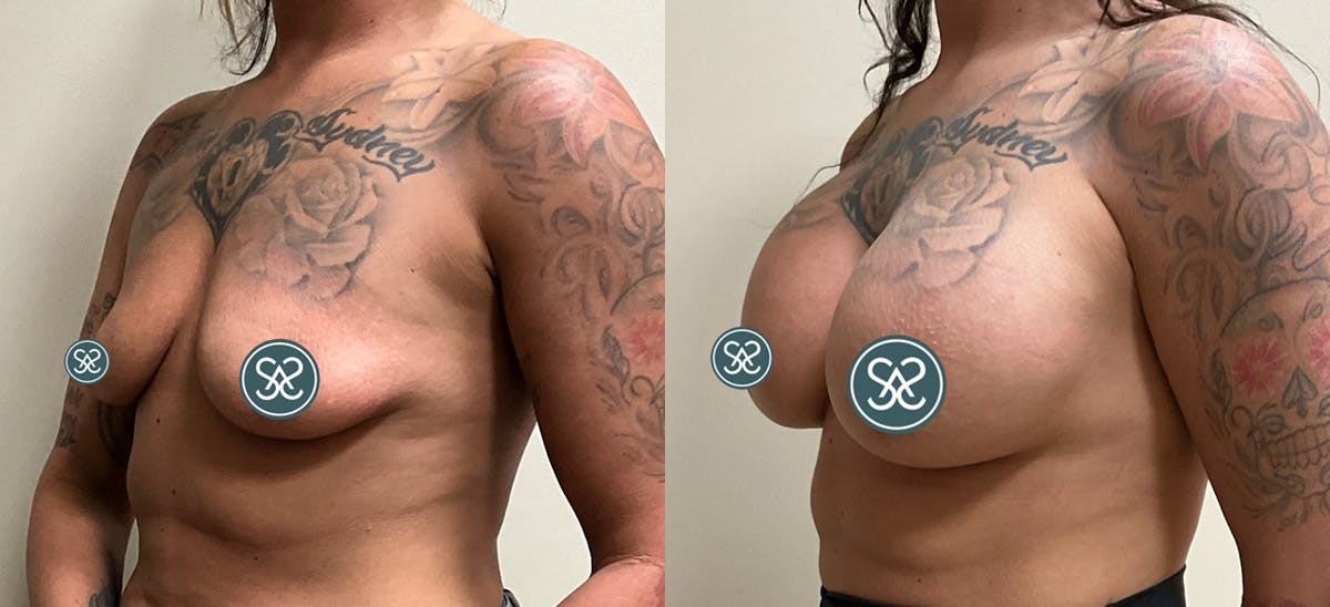 Breast Augmentation Before & After Gallery - Patient 110733 - Image 3