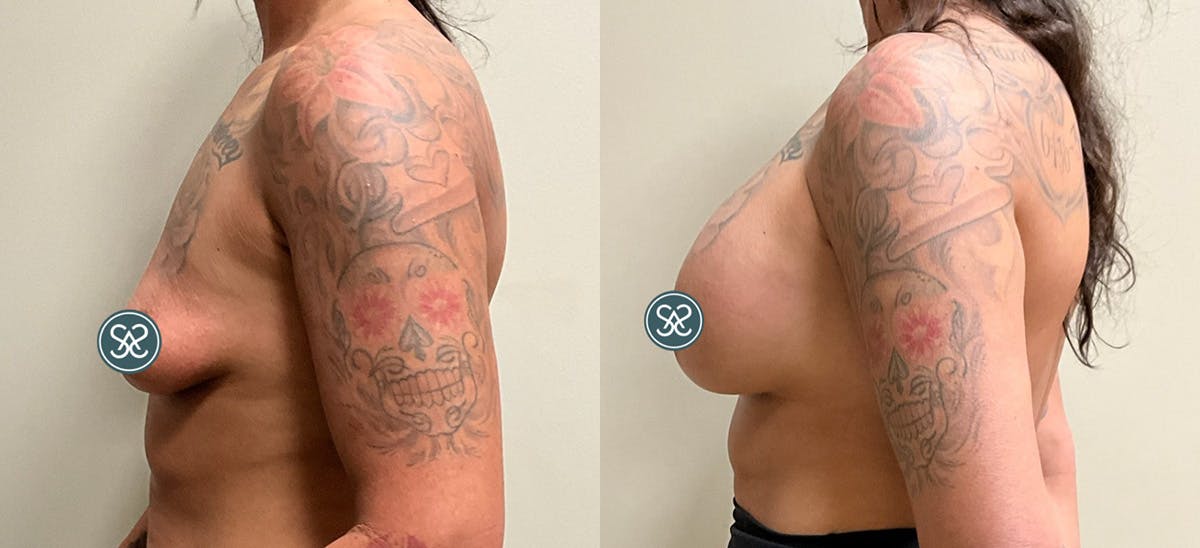 Breast Augmentation Before & After Gallery - Patient 110733 - Image 4