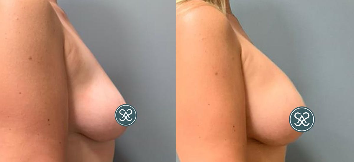 Breast Augmentation Before & After Gallery - Patient 904651 - Image 2